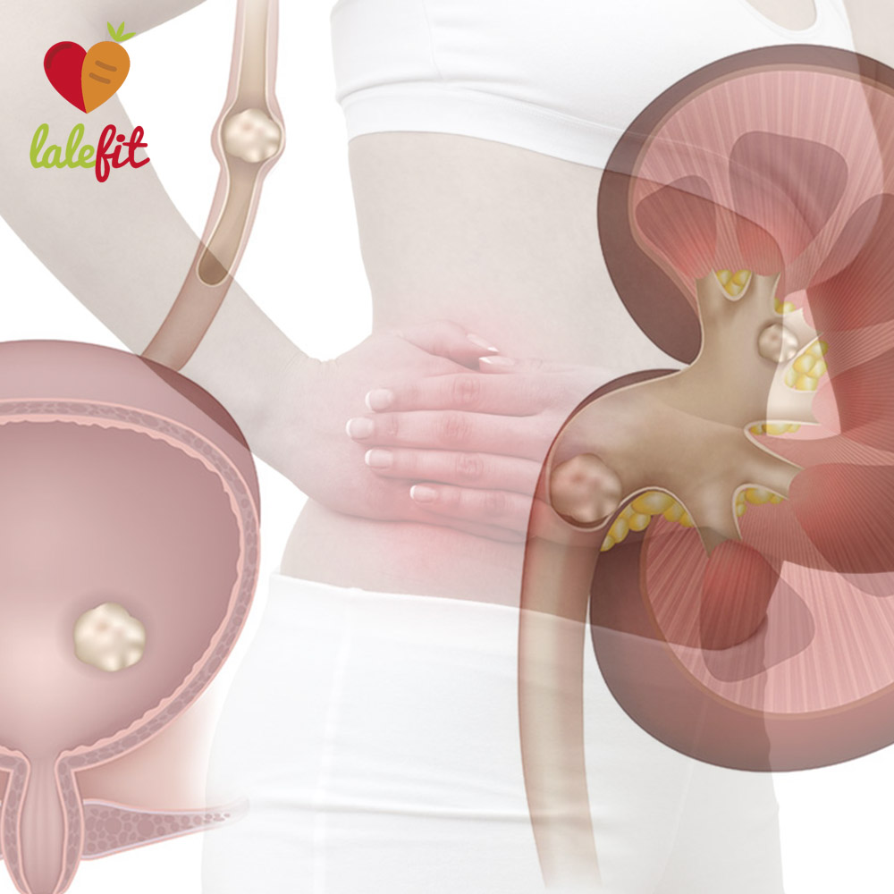 Recommendations to avoid or eliminate kidney stones